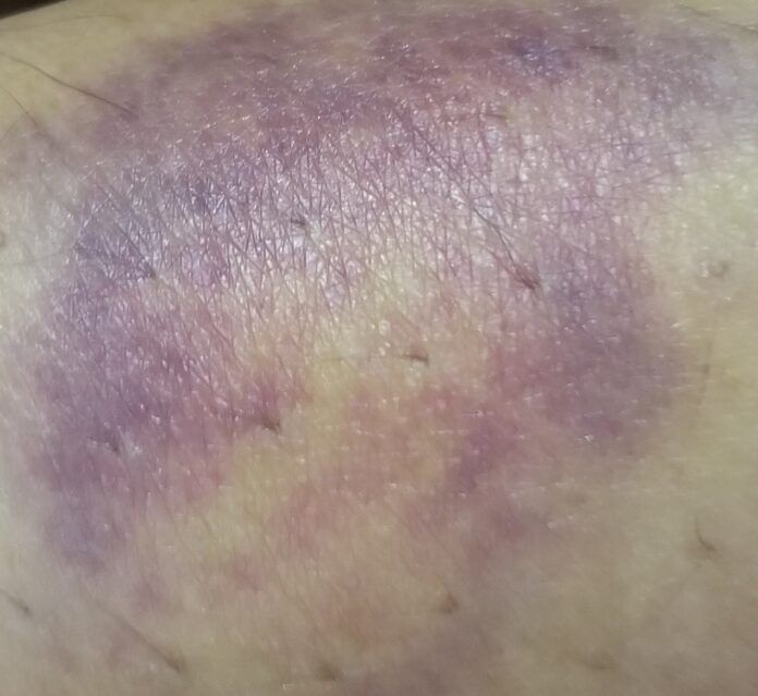 Skin Bruise